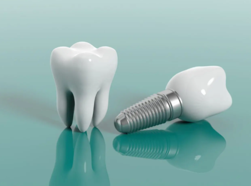 Trồng Răng Implant Tại Nha Khoa 4P – Giải Pháp Hoàn Hảo Cho Người Mất Răng